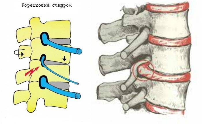 กลุ่มอาการของโรค Radicular