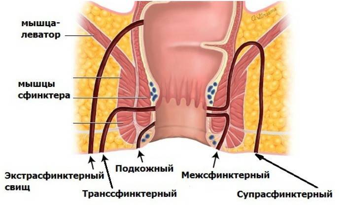 Clasificarea fistulei